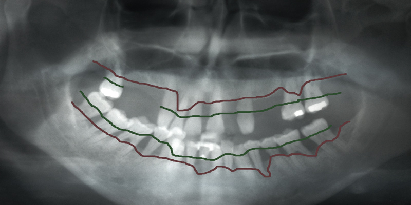 Periodontal Screaning at PERFECT SMILE